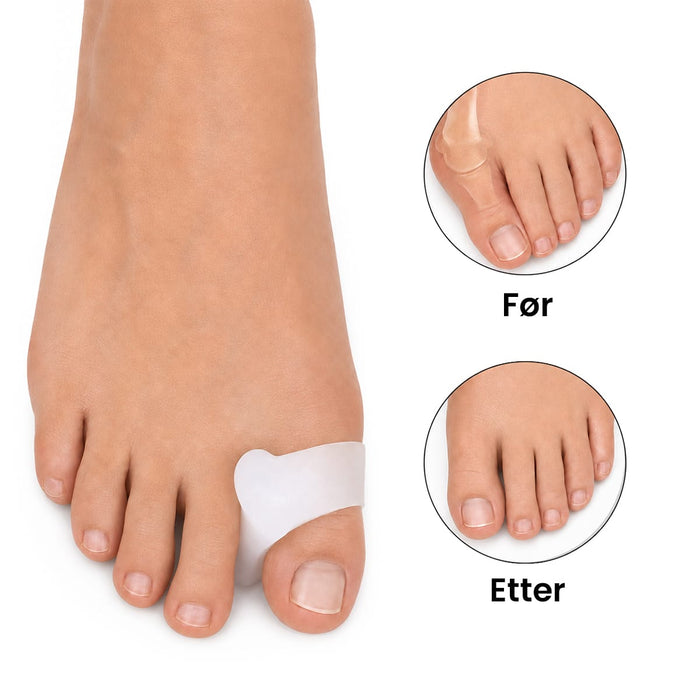 Hallux valgus tåutjevner