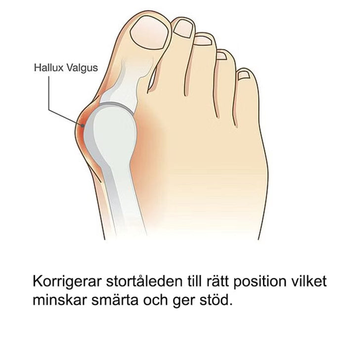 Kroppsbutiken Hallux valgus Standardtittel Hallux valgus silikonbeskyttelse