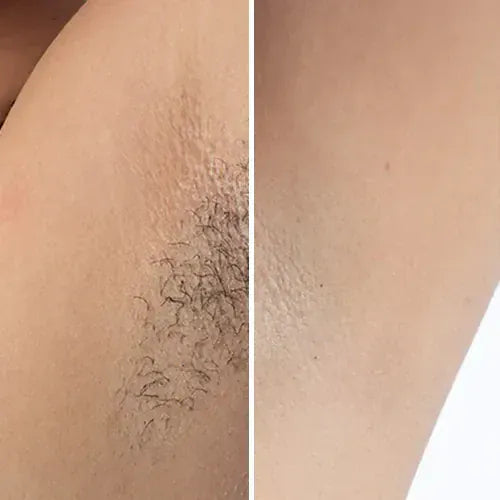 Kroppsbutiken Hårfjerner Standardtittel IPL Pro Laser Hårfjerner